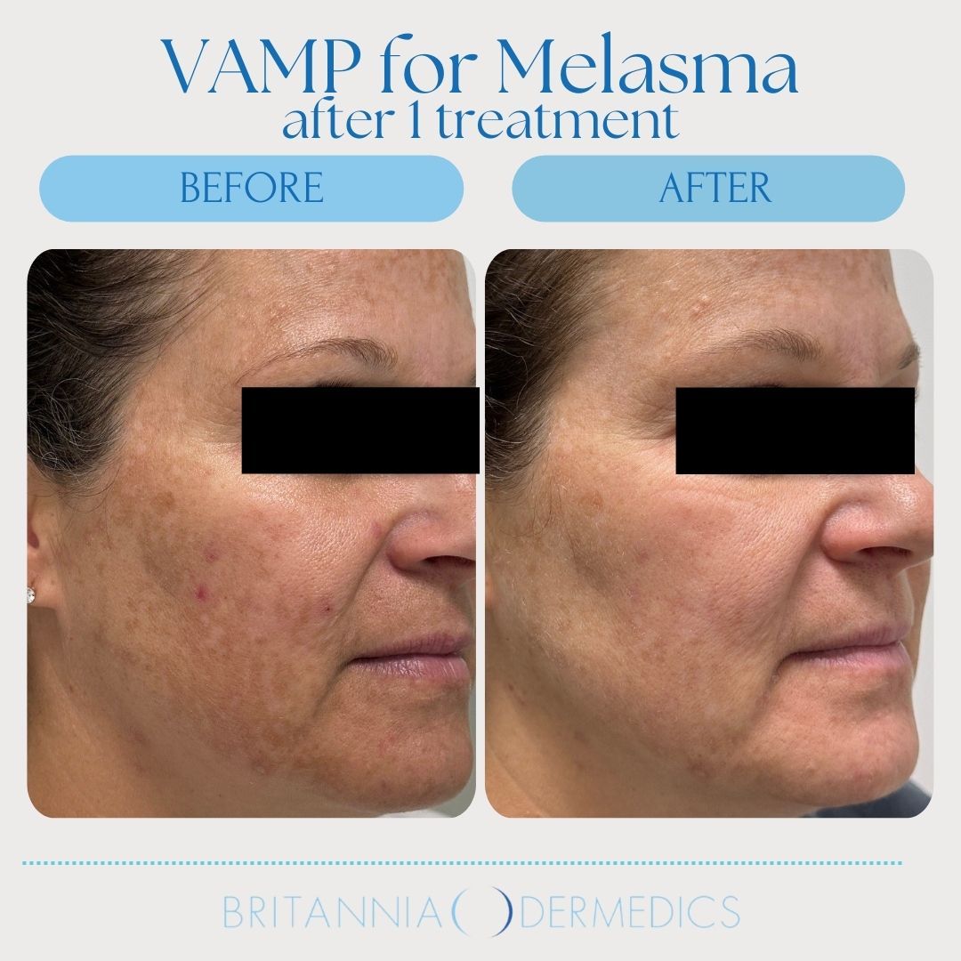 Comparison of a person's face before and after VAMP treatment for melasma, showing reduced dark spots.