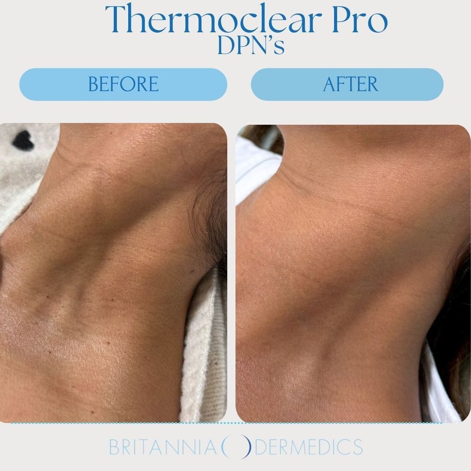 Before-and-after close-up of neck skin showing smoother appearance after Thermoclear Pro treatment.