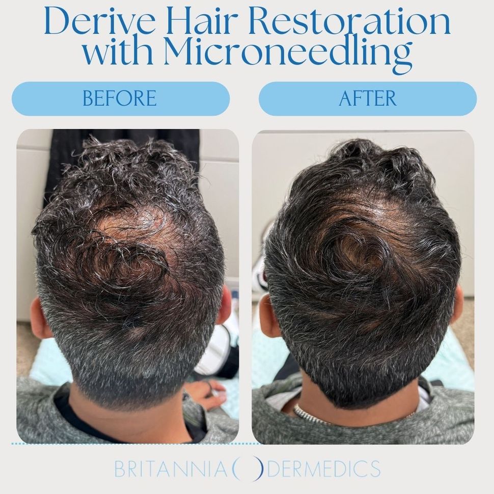 Before-and-after scalp photos showing hair restoration results with microneedling