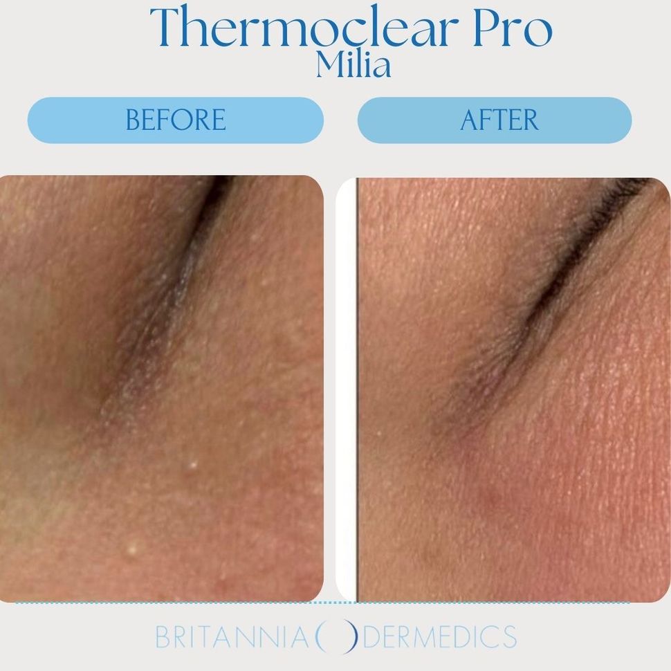 Thermoclear Pro Milia before-and-after close-up of skin, showing reduced milia bumps and redness.