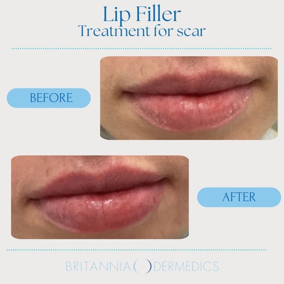 Lip filler treatment for scar, showing before and after close-ups of lips with improved symmetry