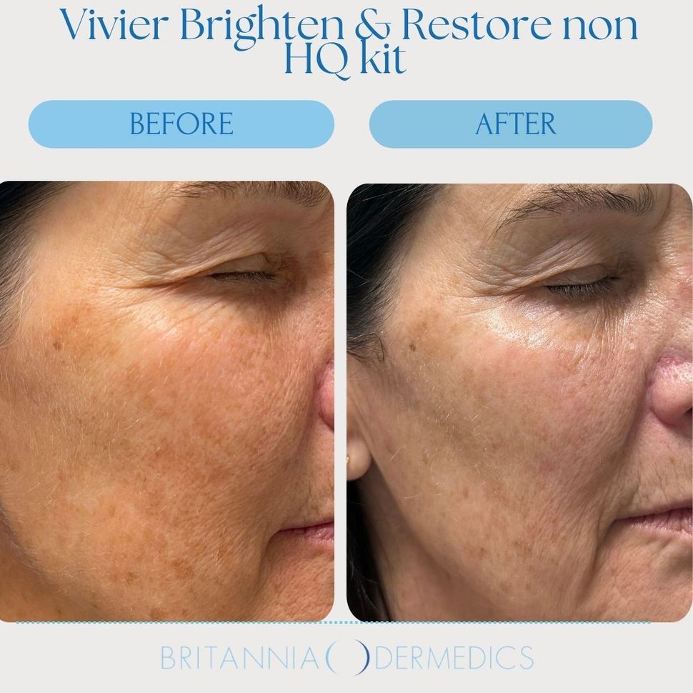 Before-and-after side profile of a woman’s cheek showing skin texture improvement from Vivier Brighten & Restore non-HQ kit.