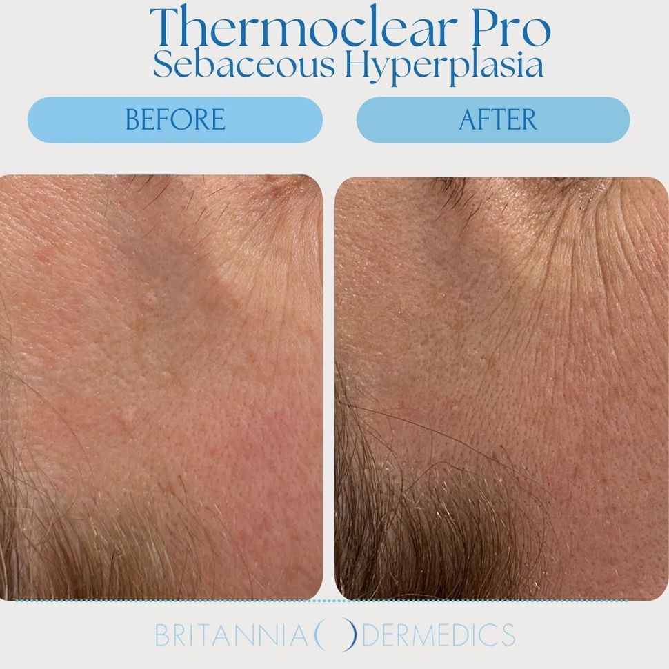 Before-and-after close-up of underarm skin showing reduced hair and smoother skin after Thermoclear Pro treatment