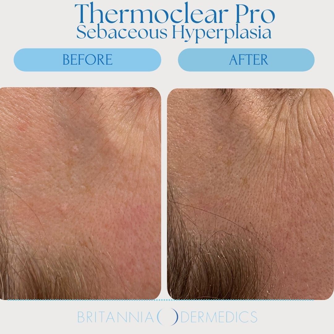 Comparison of skin before and after Thermoclear Pro treatment for sebaceous hyperplasia.