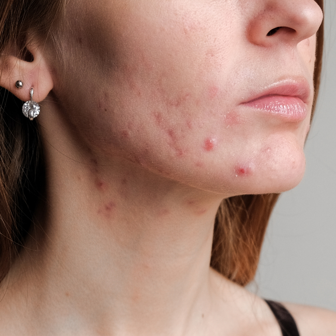 Woman with flushed, red cheeks and nose, likely rosacea.