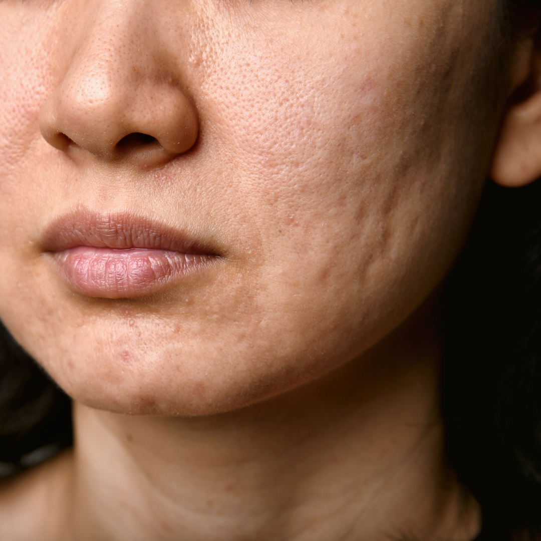 Close-up of a face with uneven skin tone, freckles, and a light-colored scar.