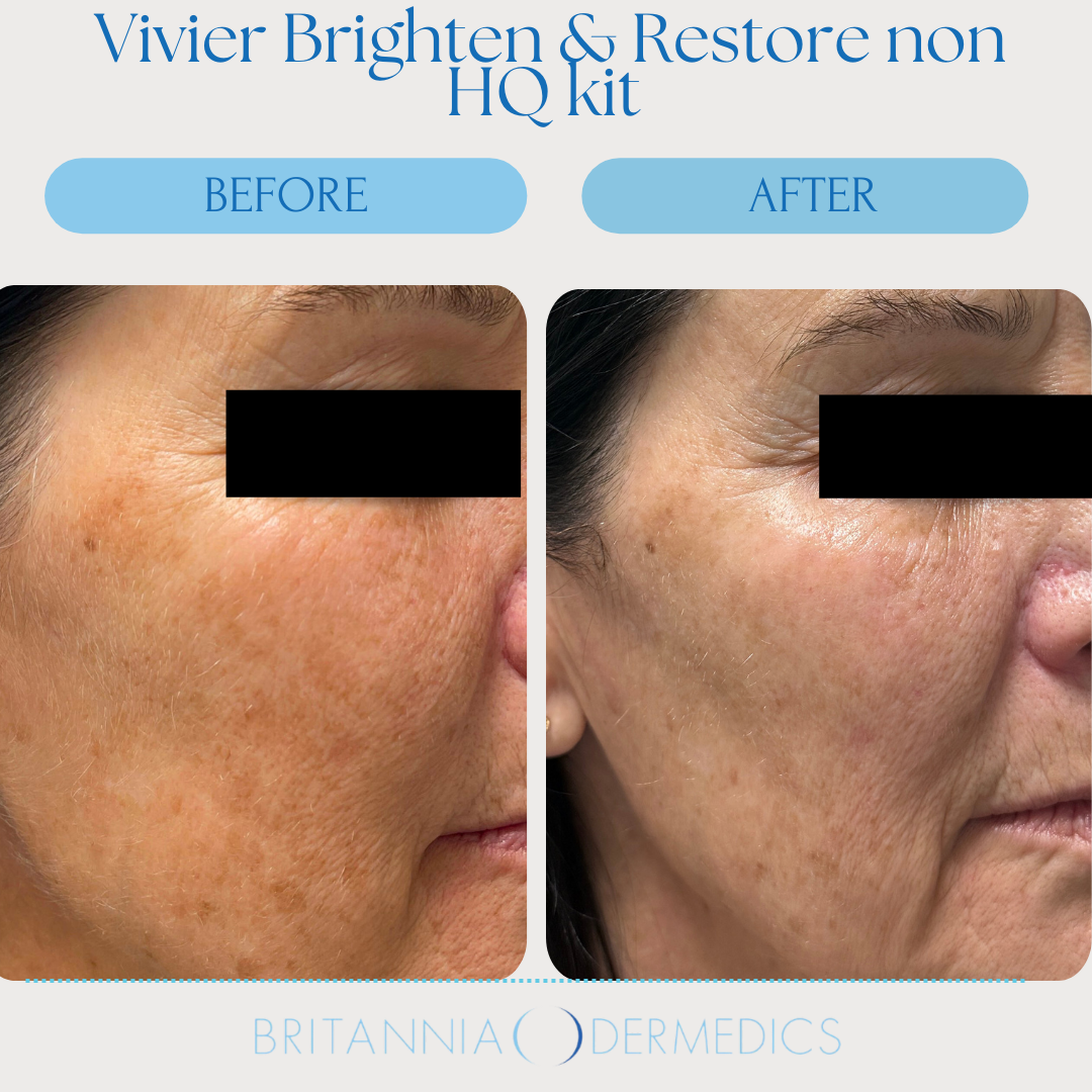 Before-and-after skin treatment. Face with dark spots becomes lighter after using Vivier Brighten & Restore non-HQ kit.