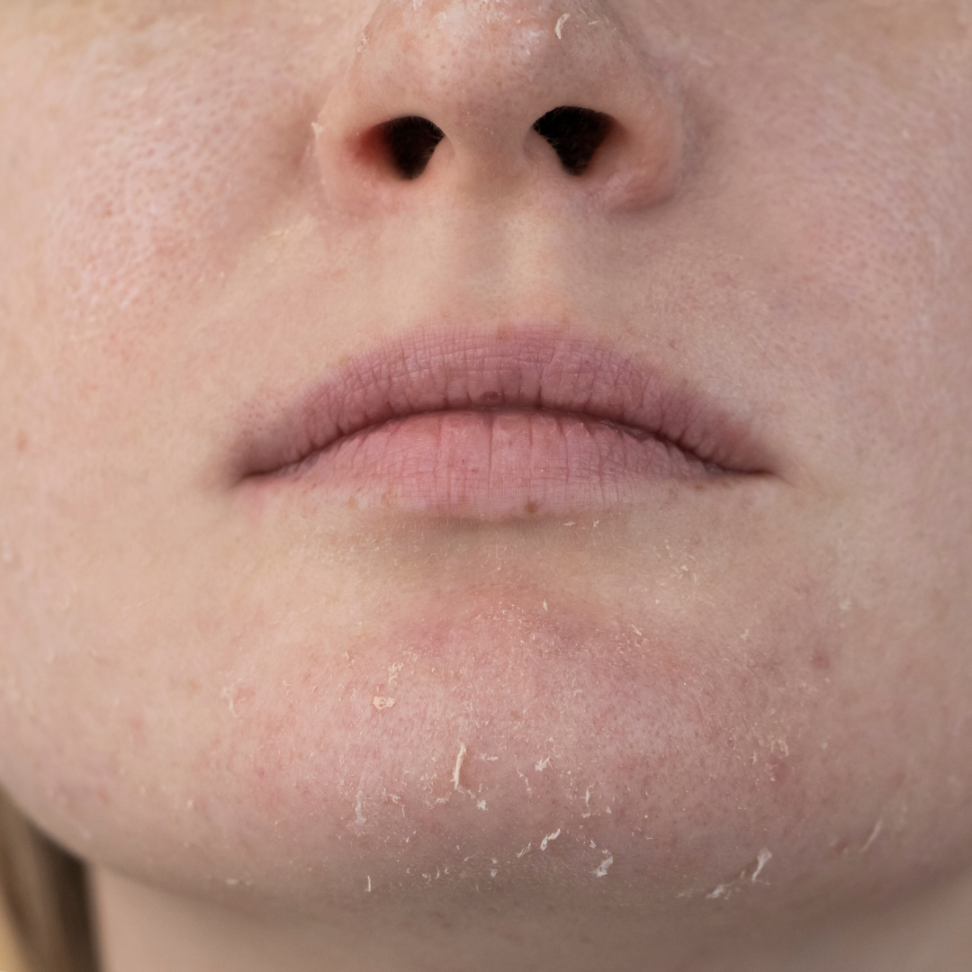 Close-up of a person's face with visible dark patches on the cheek, likely hyperpigmentation.