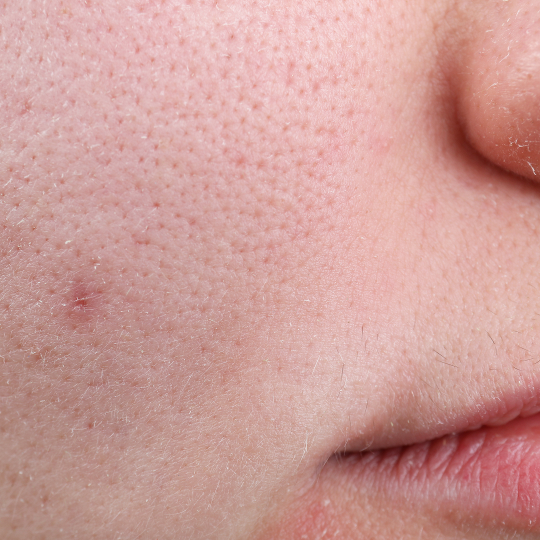 Close-up of human facial skin with prominent pores on the cheek.