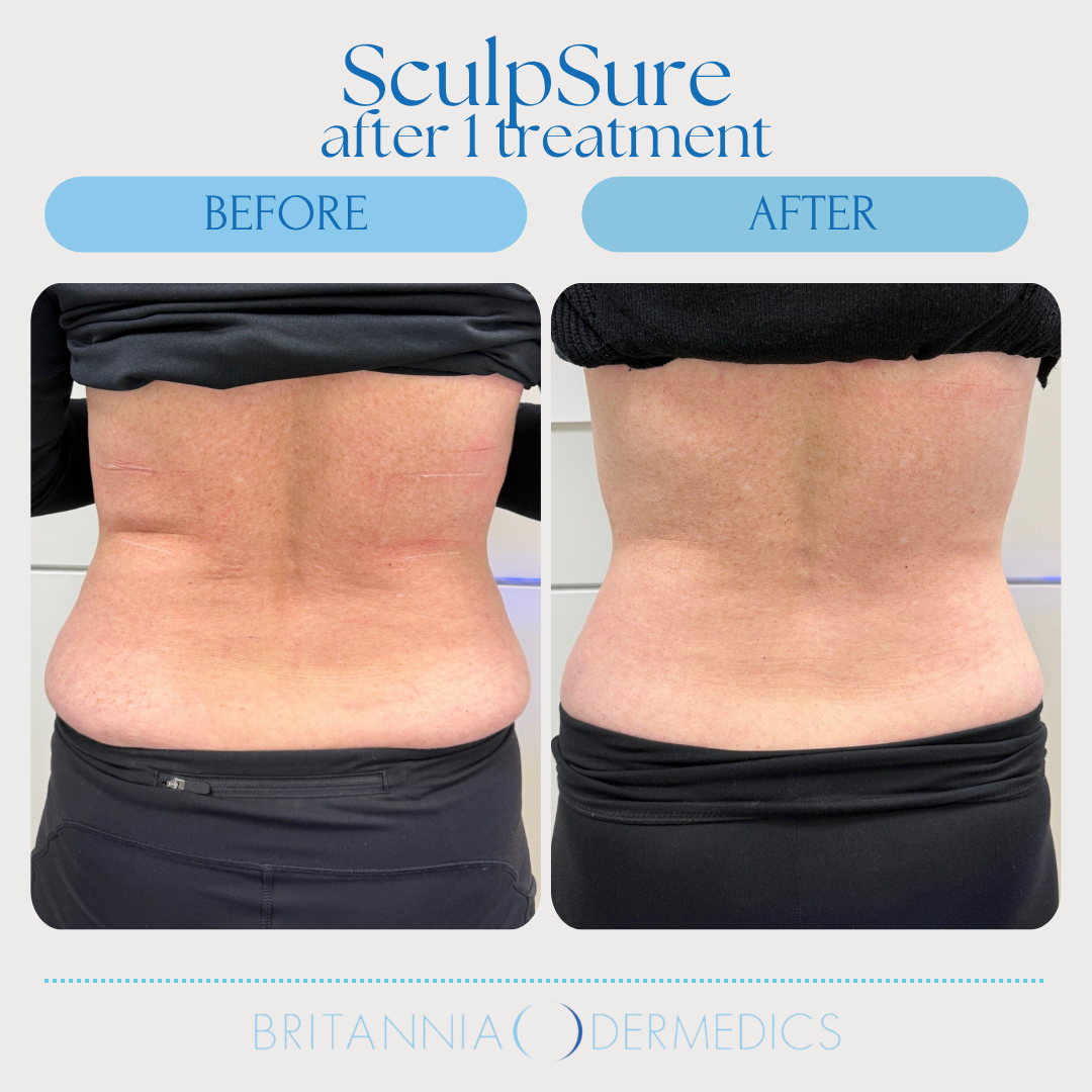 Comparison of a person's waist before and after a SculpSure treatment; showing reduction of fat.