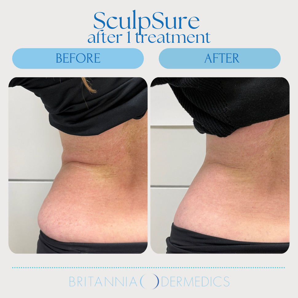 Before-and-after side view of lower back and waist after SculpSure treatment, showing reduced bulge.