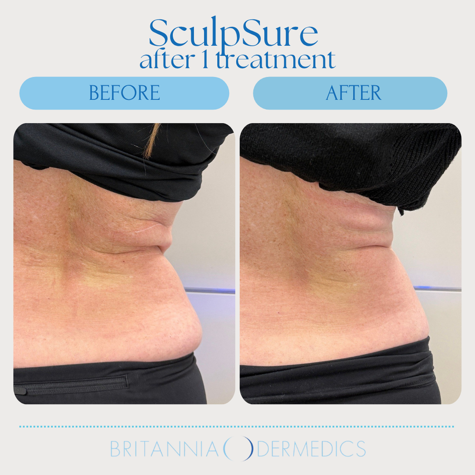 Before-and-after side view of neck after SculptSure treatment, showing reduced under-chin fullness.