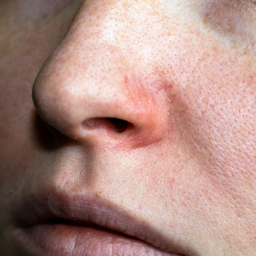 Close-up of a person's eye and face, showing visible capillaries and skin discoloration.