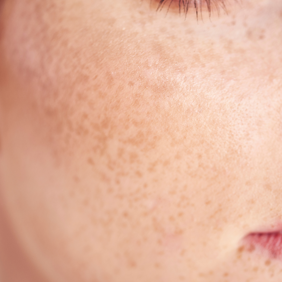 Hand applying cream to face with brown spots.