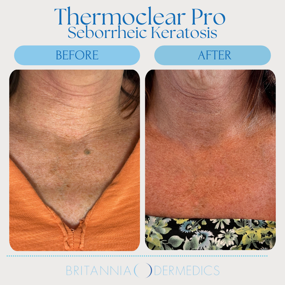 Thermoclear Pro ad showing neck skin before and after seborrheic keratosis treatment