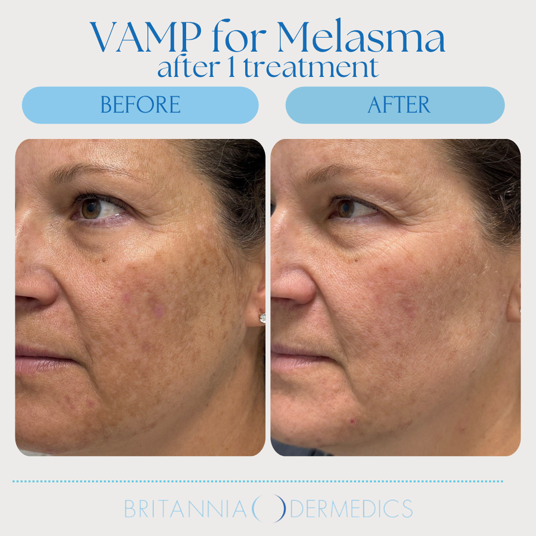 Side-by-side comparison of a person's face. Before and after VAMP melasma treatment, with reduced dark spots.