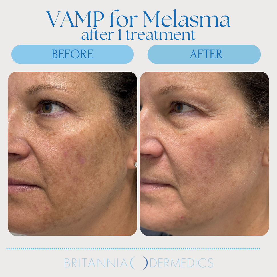 Before-and-after facial skin close-up showing melasma improvement after VAMP treatment.