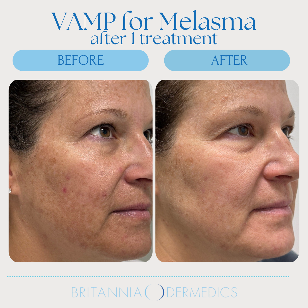 Before/after photos of a woman's face, showing a reduction in melasma after VAMP treatment.