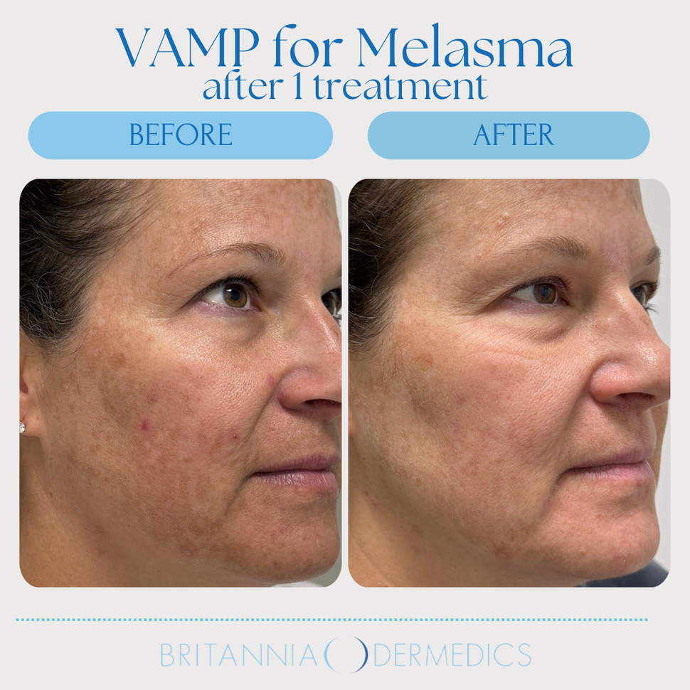 Before-and-after facial photos labeled “Vamp for Melasma after 1 treatment,” showing reduced facial discoloration.