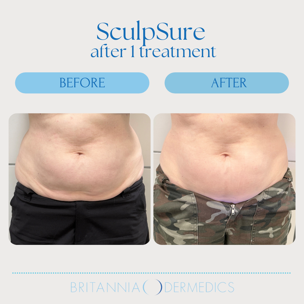 Before-and-after SculpSure treatment comparison of lower abdomen, showing reduced belly fullness