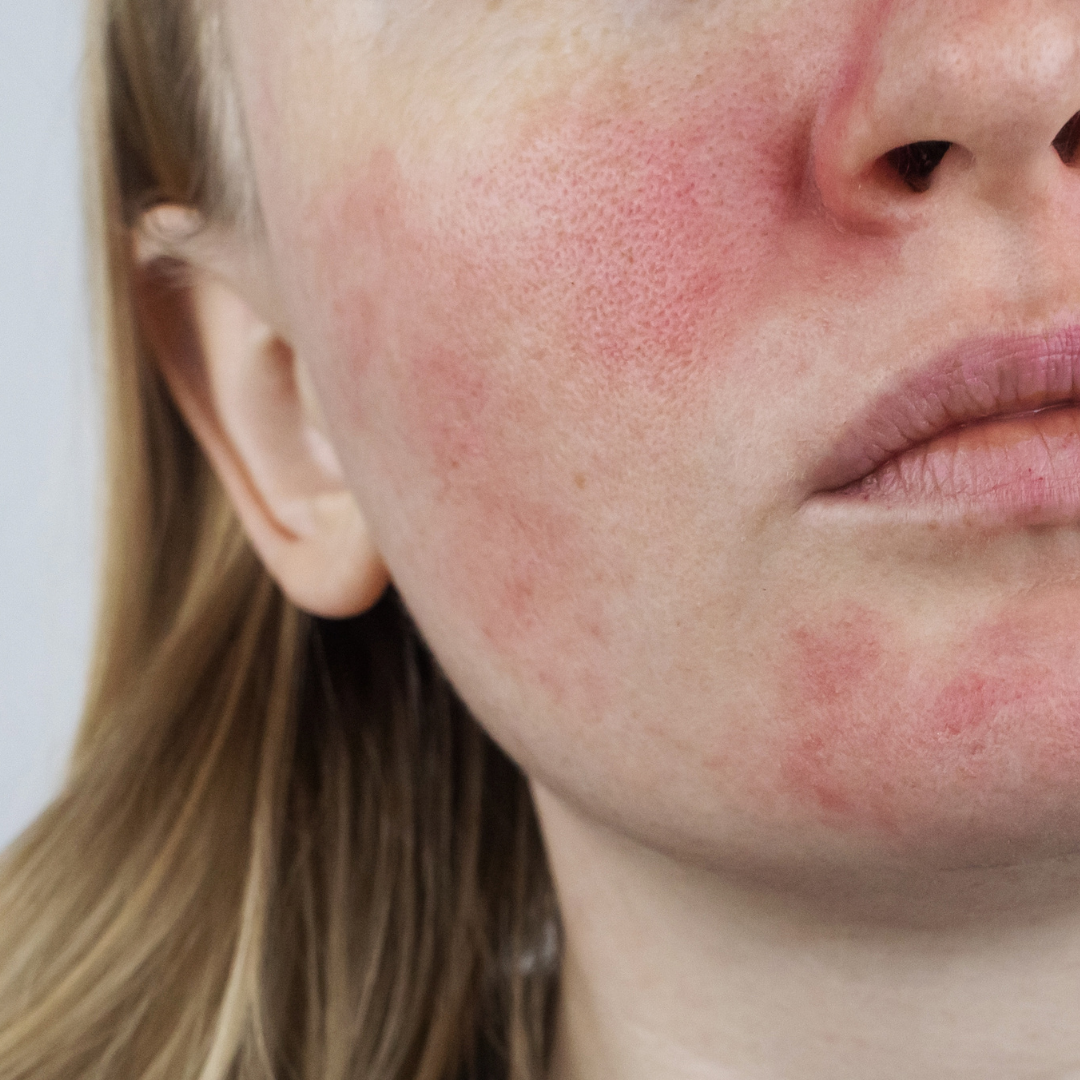 Close-up of a person's face showing skin redness, particularly on the cheeks.