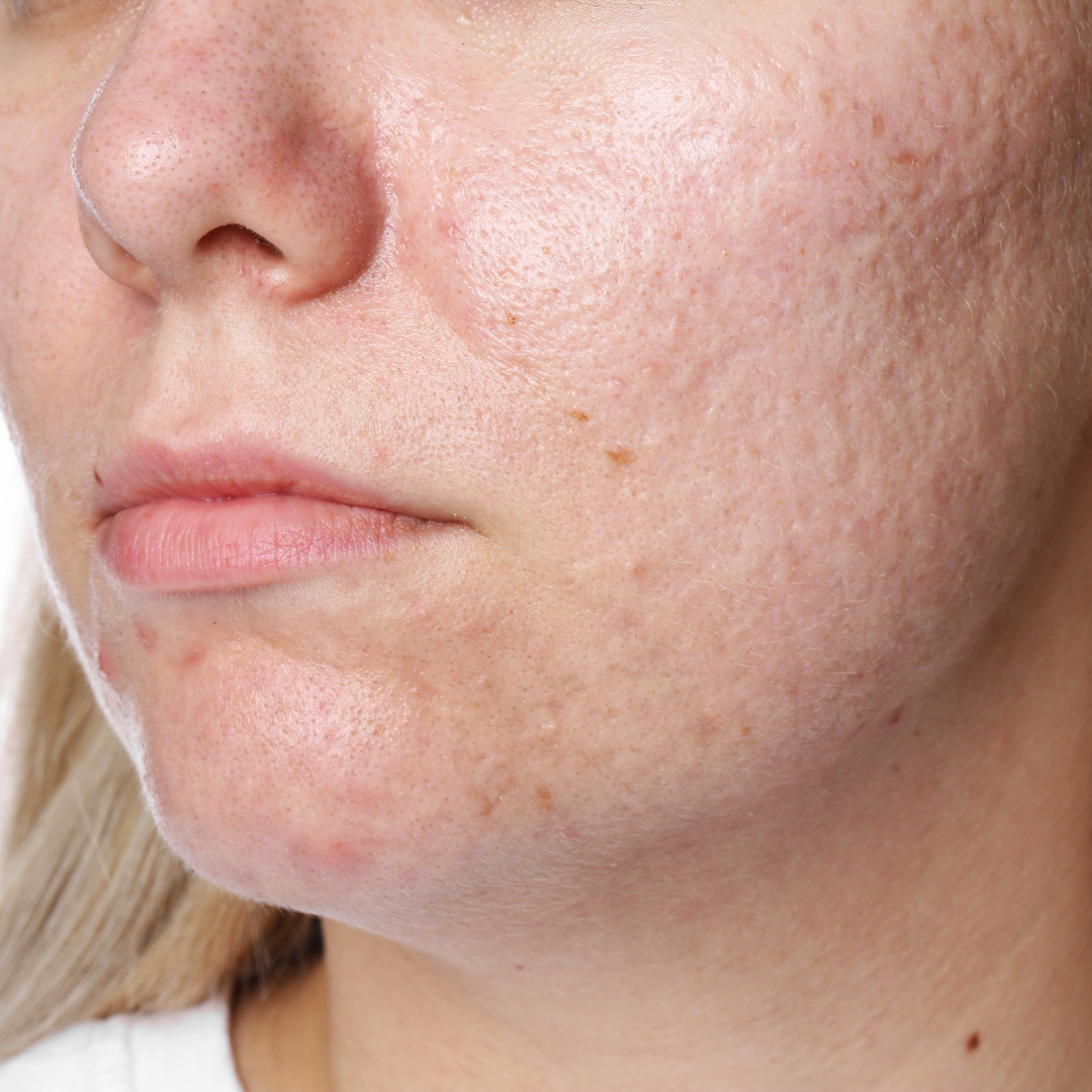 Woman with dark hair looking at the camera, light skin, and several dark spots.