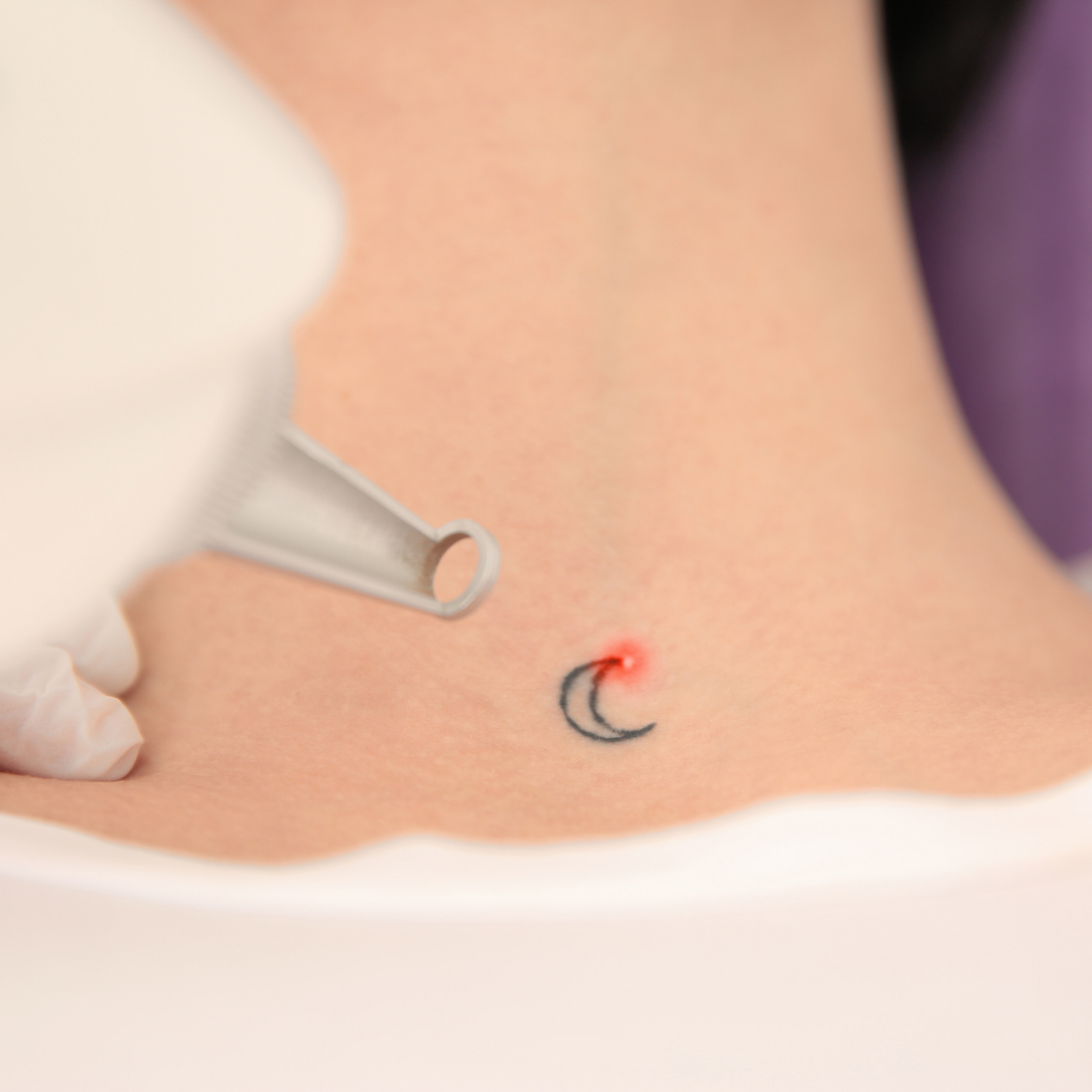 Tattoo on a person's back being treated with a laser. The tattoo is a detailed, dark pattern.