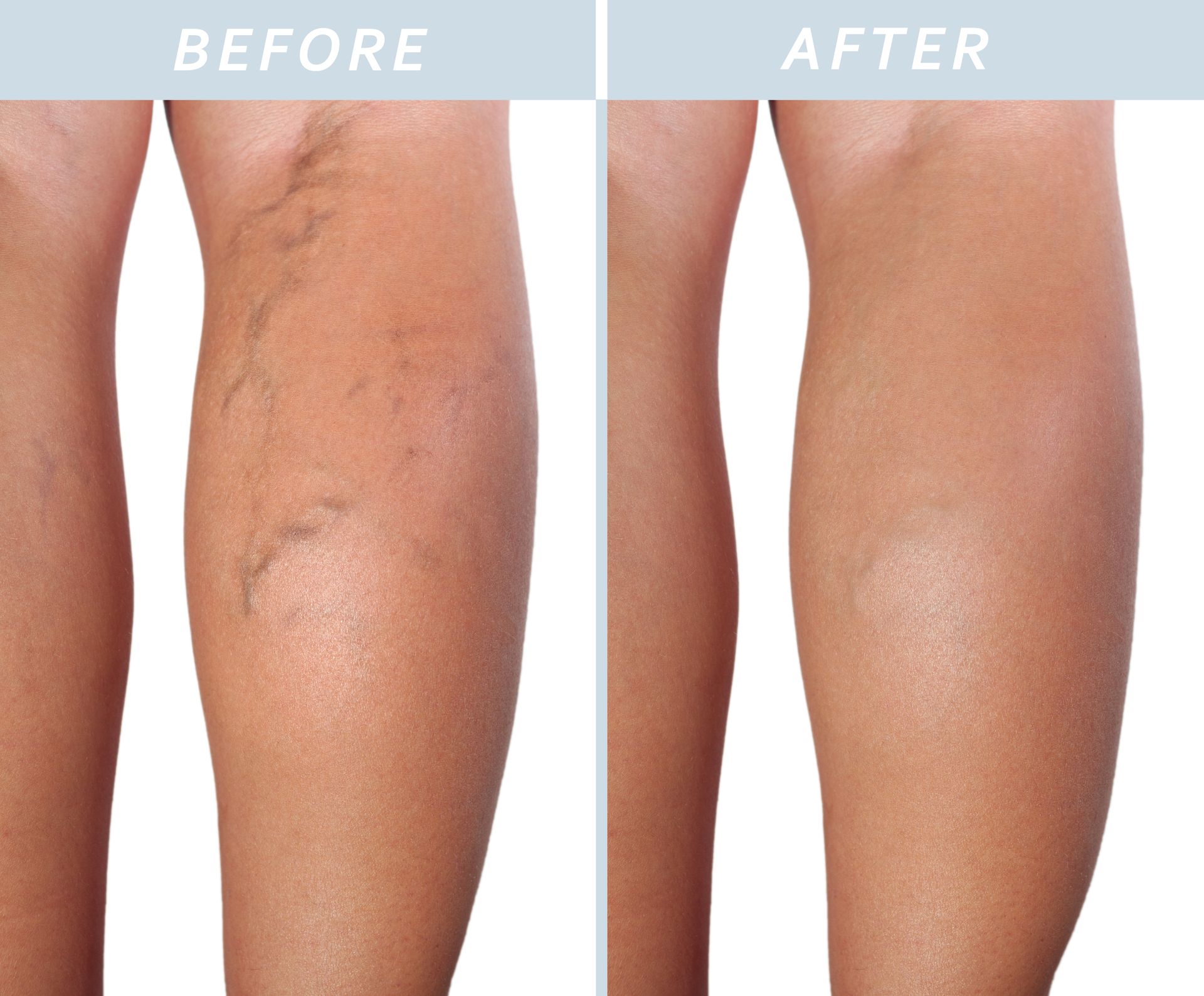 A before and after photo of a woman's legs with varicose veins