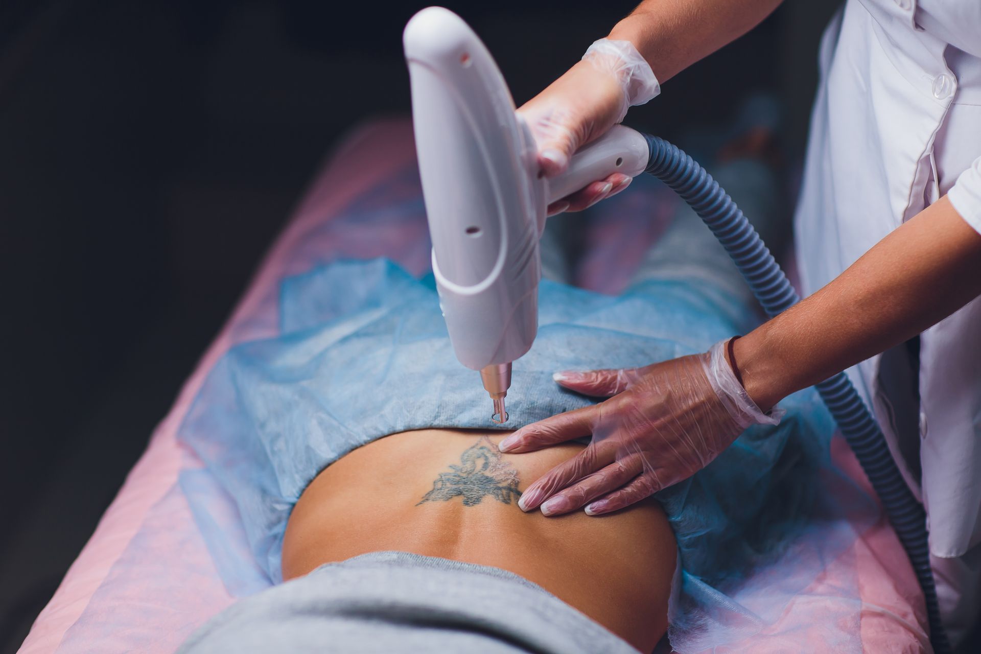 Laser tattoo removal on a person's back, a medical professional holds the device.