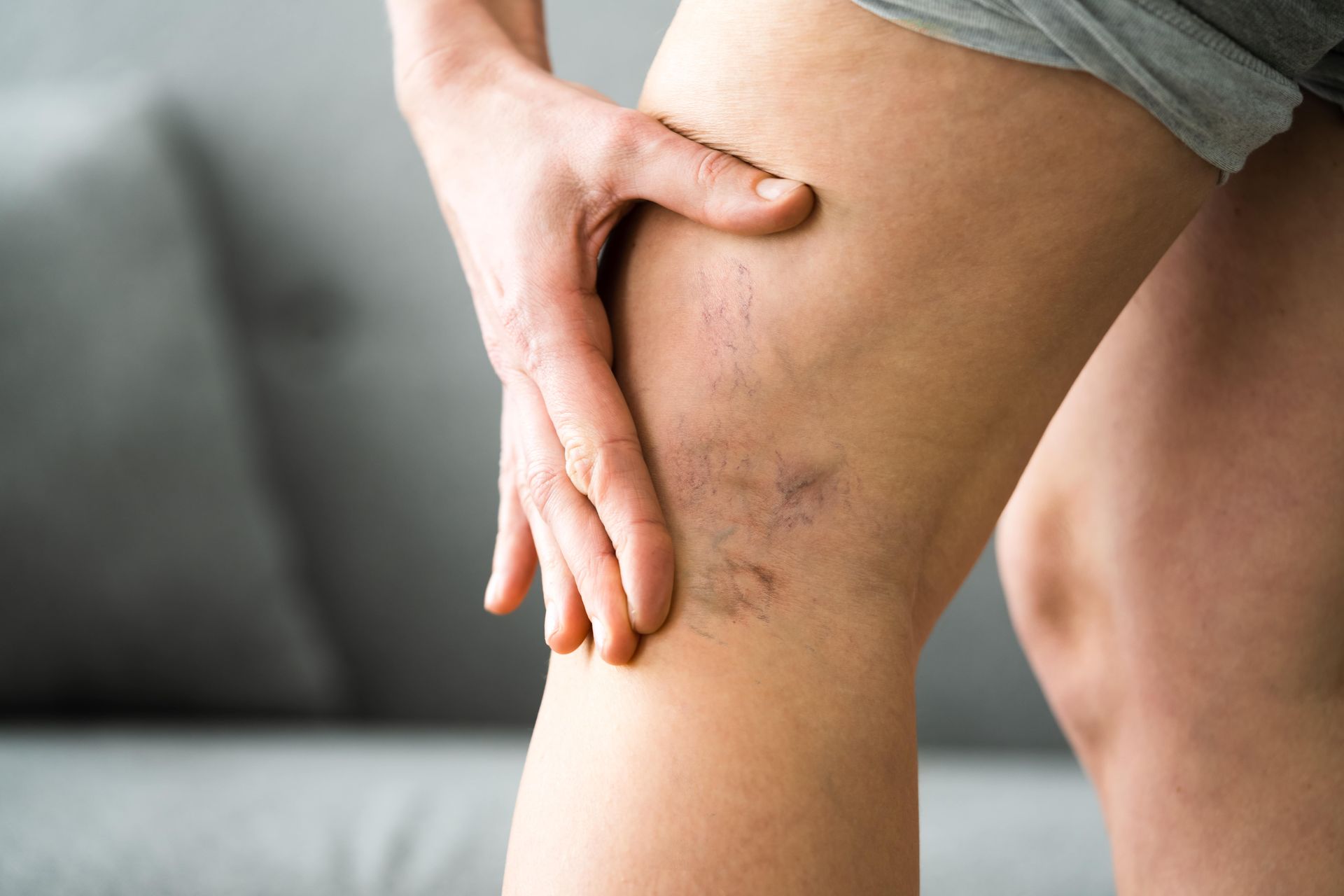A woman is holding her leg with varicose veins on it.