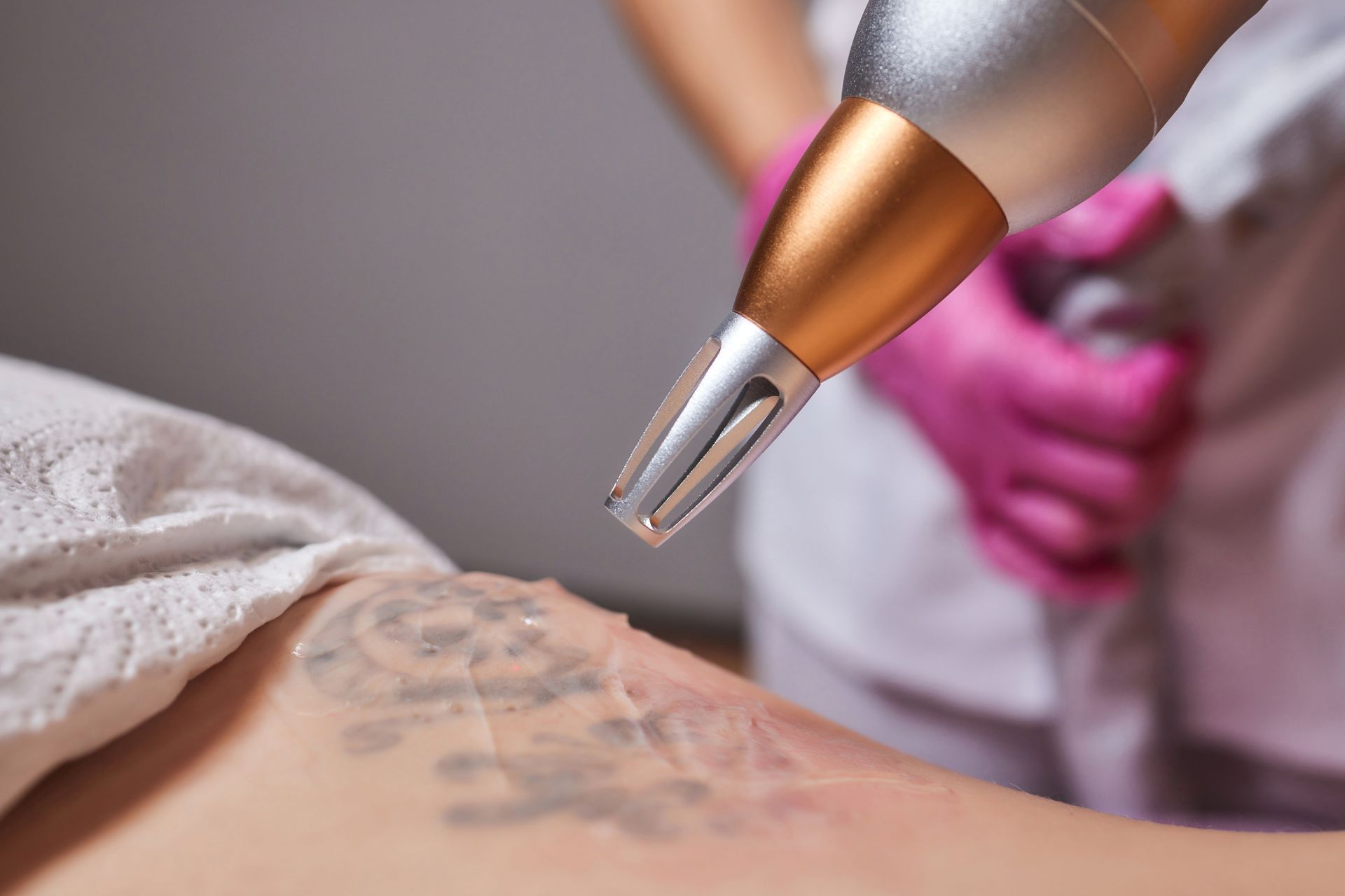 Laser tattoo removal on skin; device held by gloved hand.