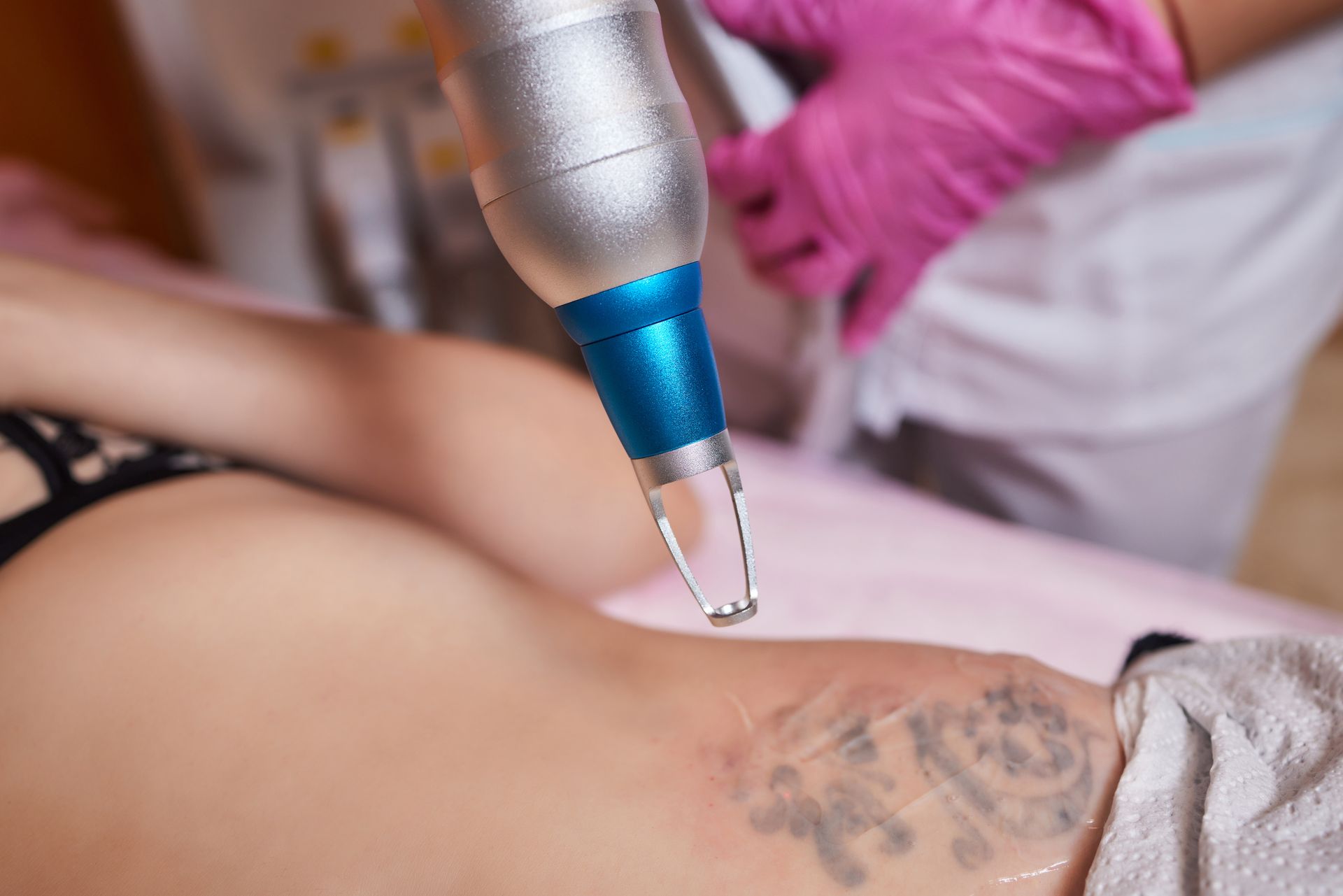 A woman is getting a tattoo removed from her back.