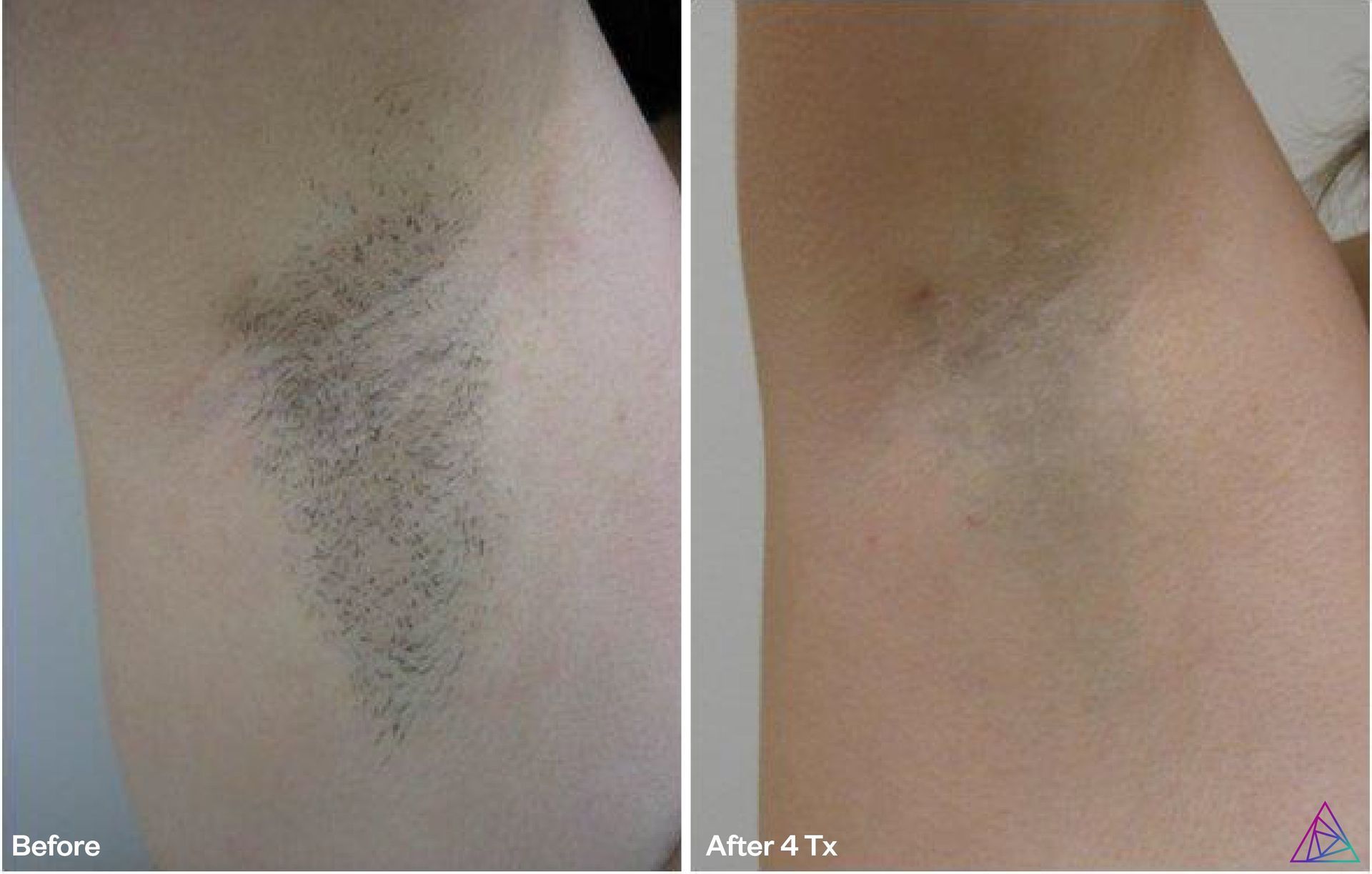 A before and after photo of a woman 's underarm