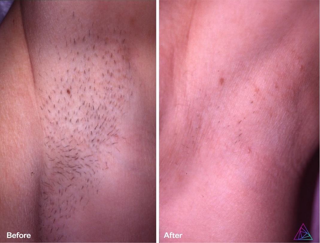 A before and after photo of a person 's underarm