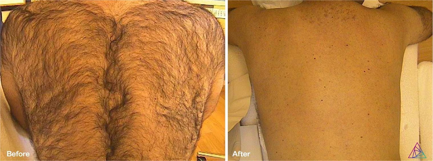 A before and after picture of a man 's hairy back.