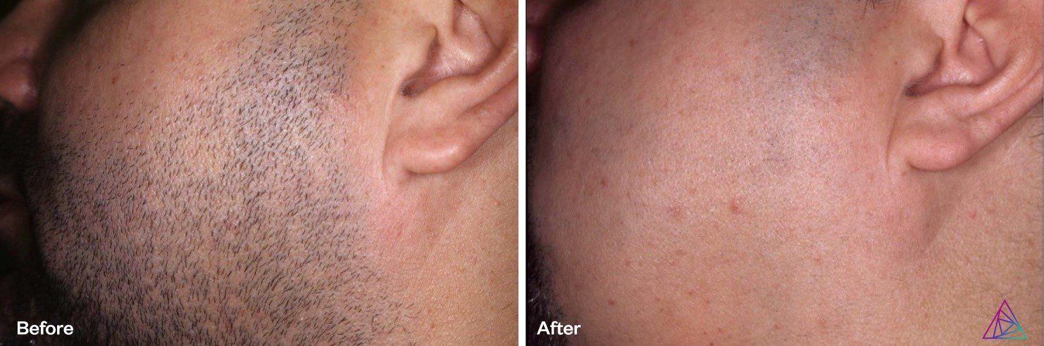 A before and after photo of a man 's face