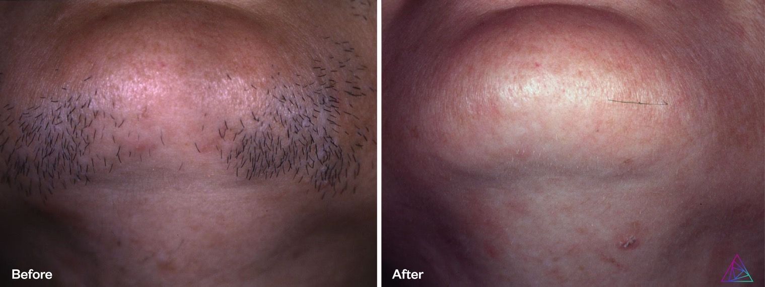 A before and after picture of a person 's face