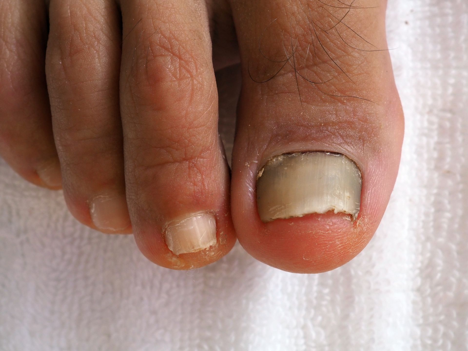 A close up of a person 's toenails on a white towel.
