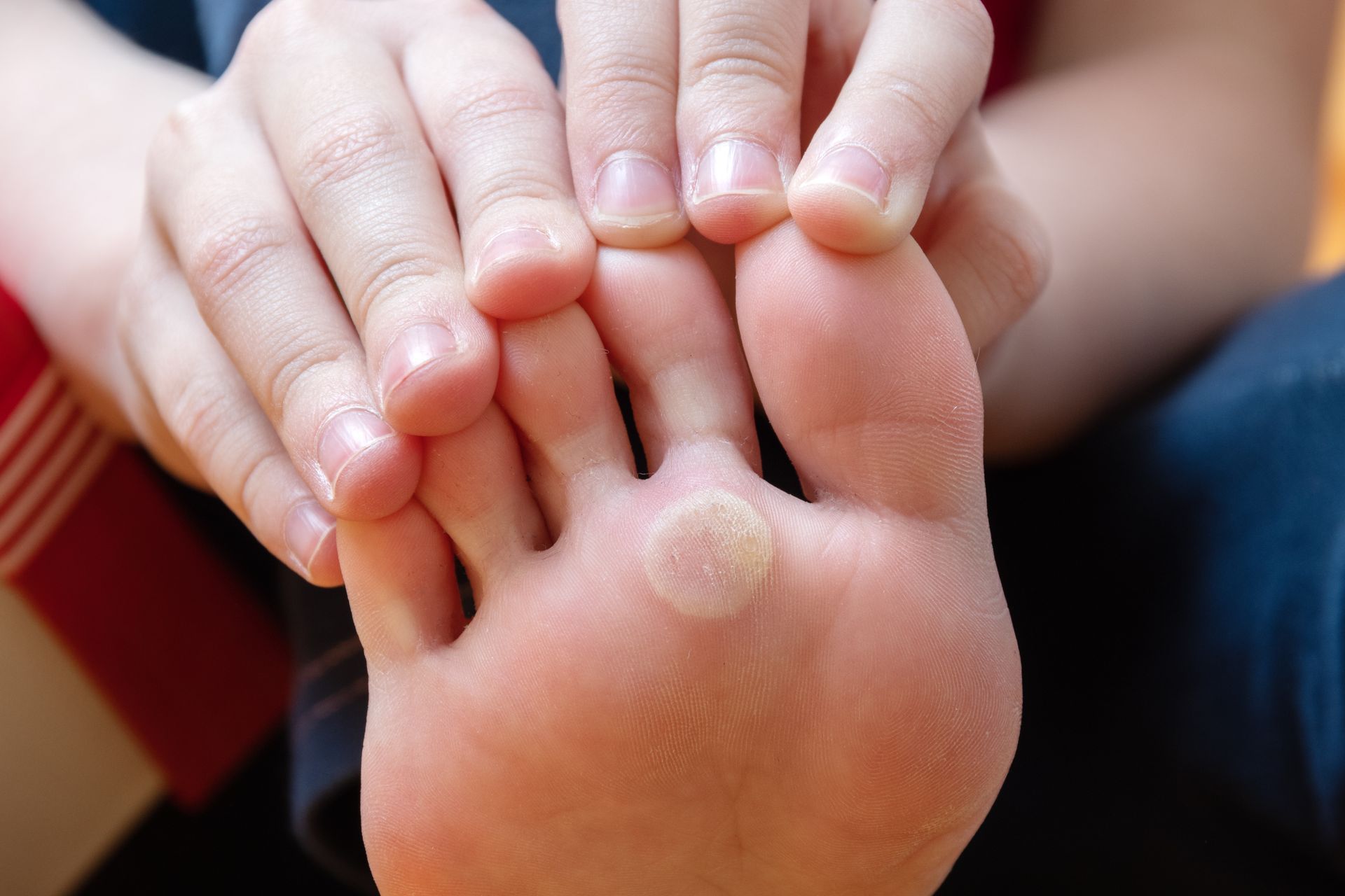 A person is holding their foot with a wart on it.