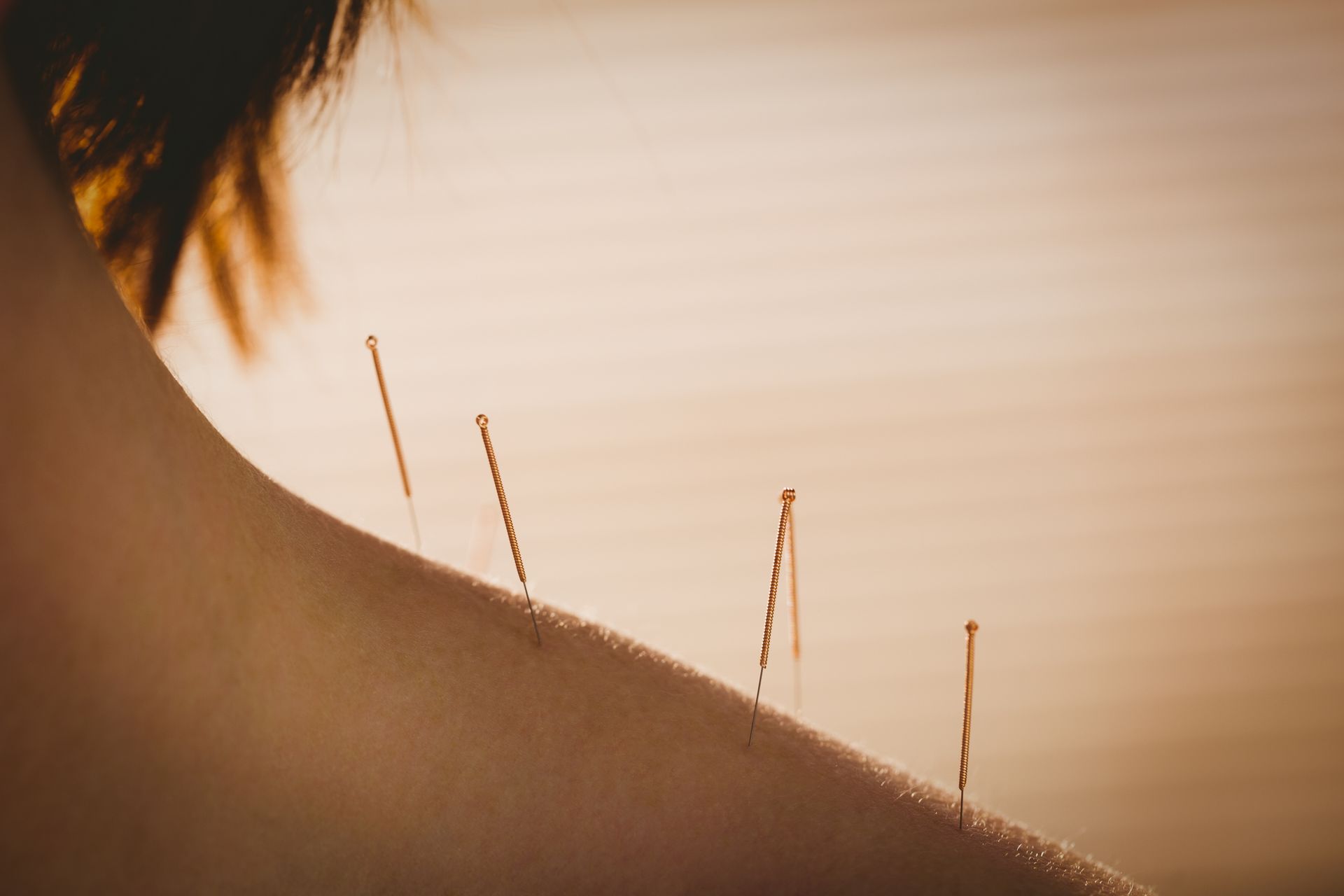 a woman is getting acupuncture on her back .