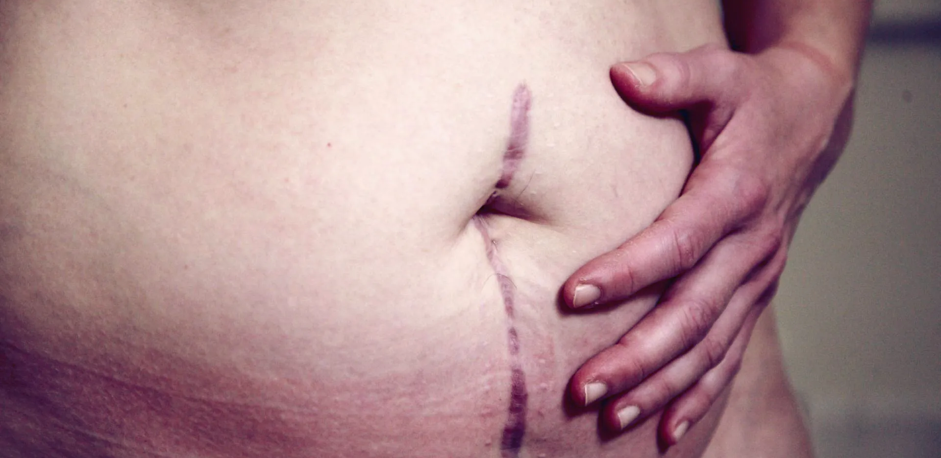 Postnatal Belly Healing