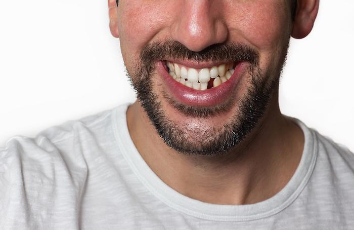 Man With Missing Tooth - Anchorage, AK - Healthy Smiles Dental