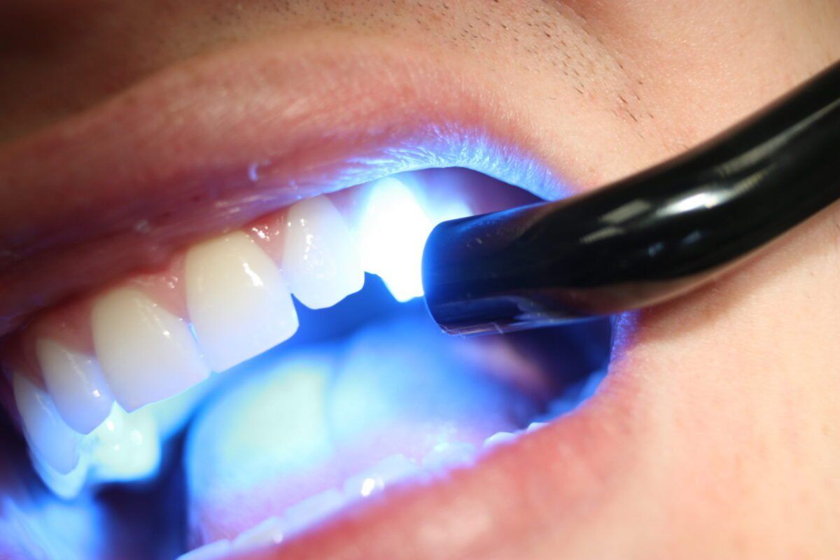 Teeth Whitening - Anchorage, AK - Healthy Smiles Dental