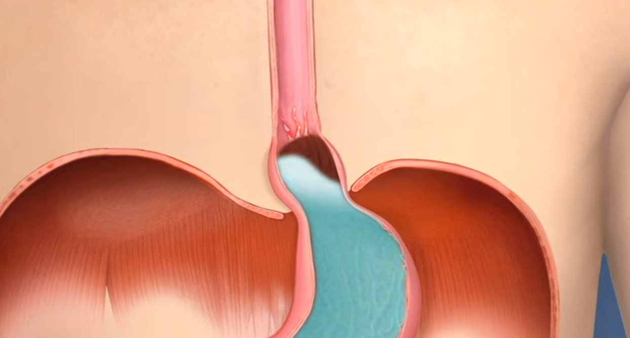 A computer generated image of a person 's stomach and esophagus.