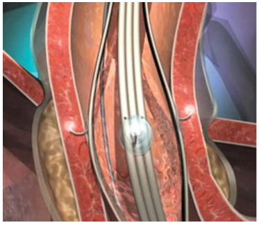 A computer generated image of a surgical procedure