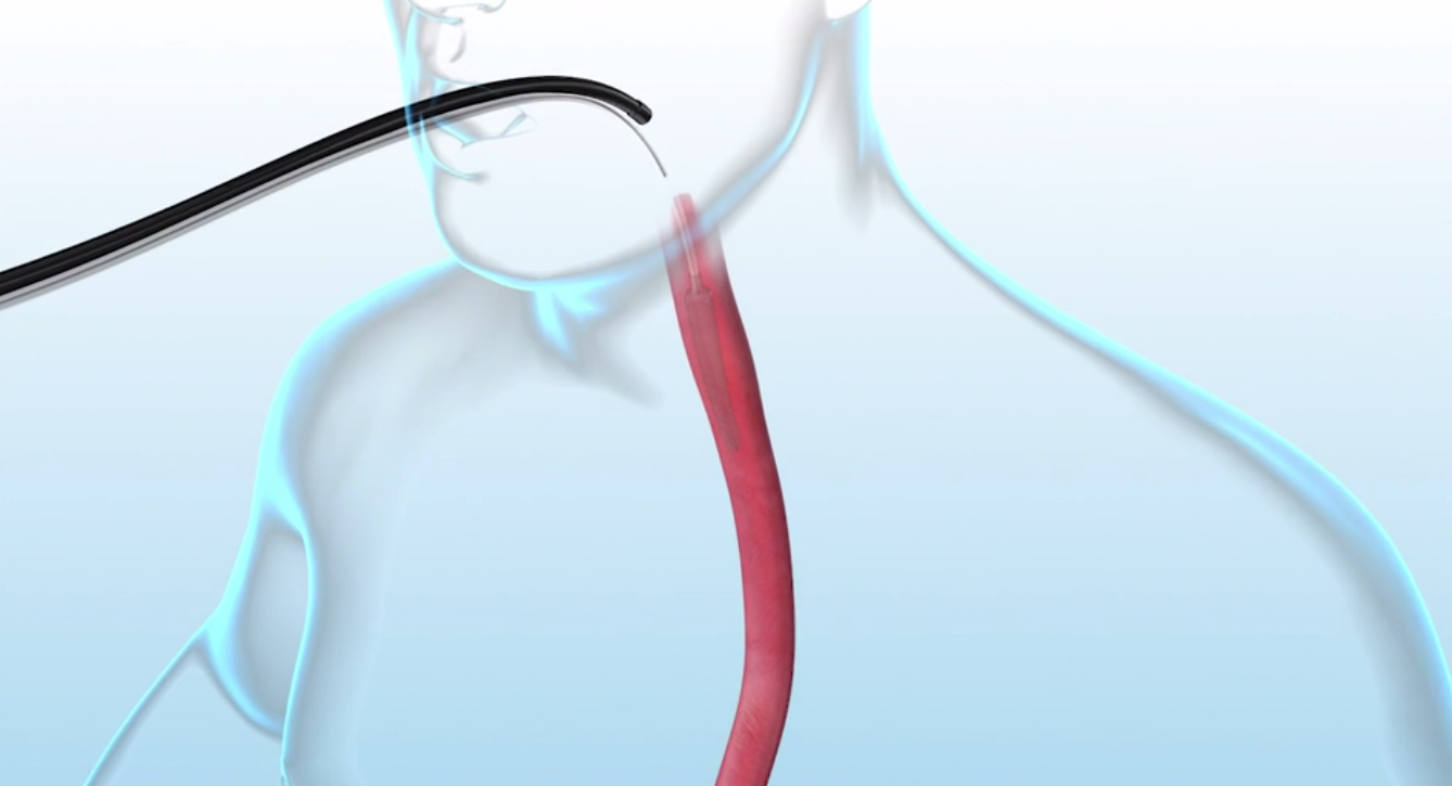 A person is being examined by a doctor with a needle in their throat.