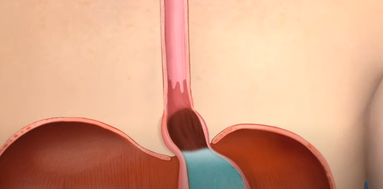 A computer generated image of a person 's esophagus and stomach.