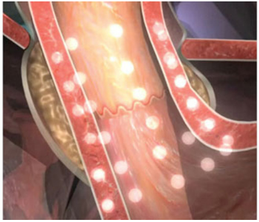 A computer generated image of a person 's stomach