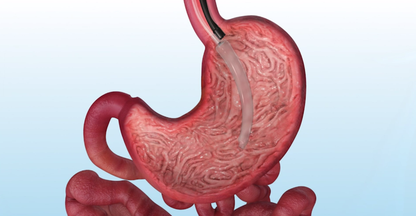 A computer generated image of a stomach with a tube coming out of it.