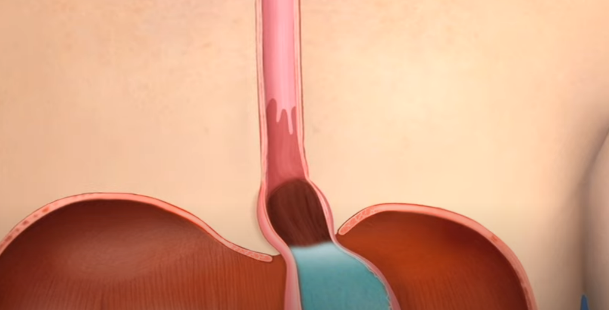 A computer generated image of a person 's esophagus and stomach.
